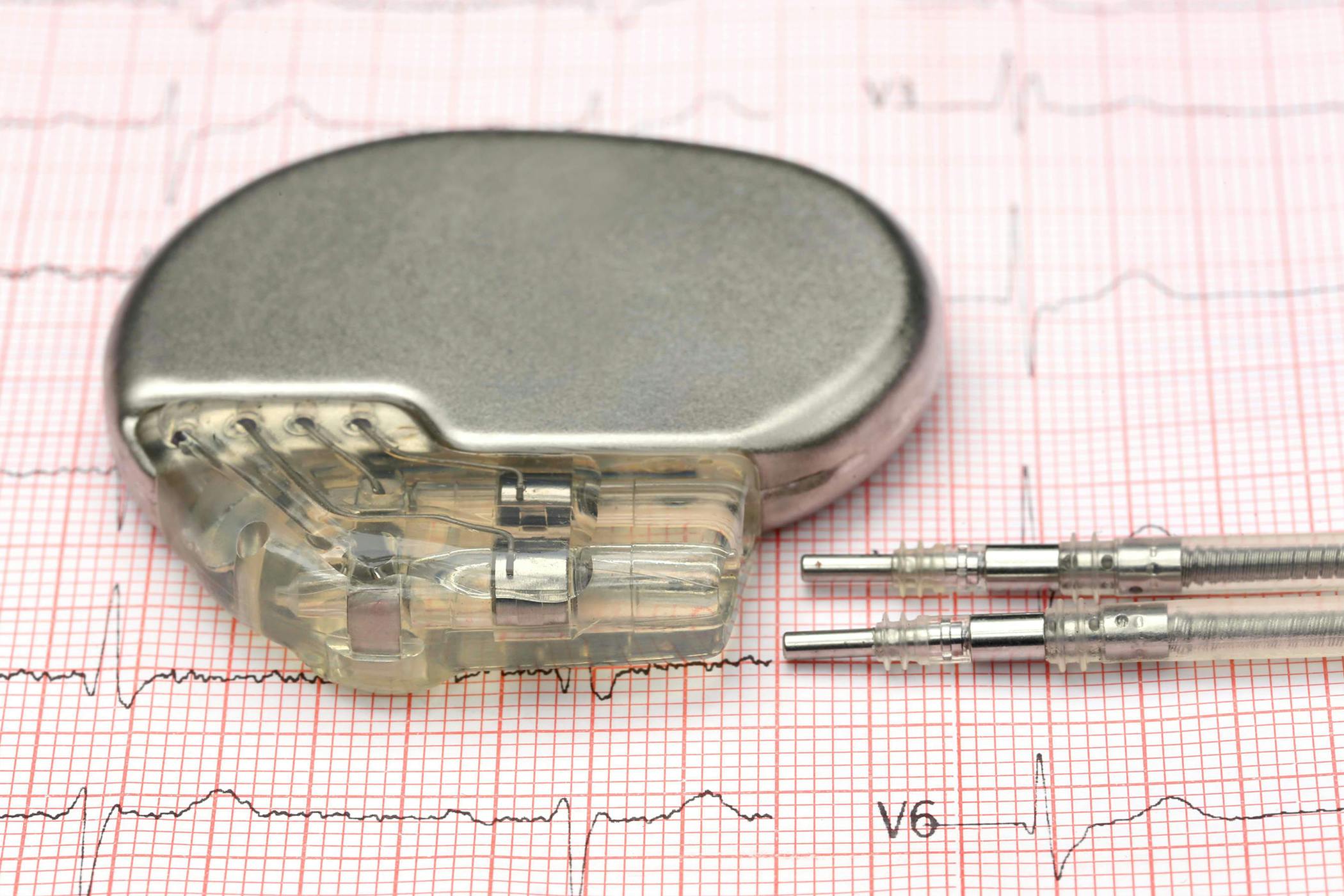 Pacemaker Implantation